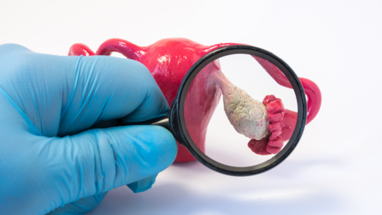 Síndrome dos ovários policísticos – temos uma epidemia?