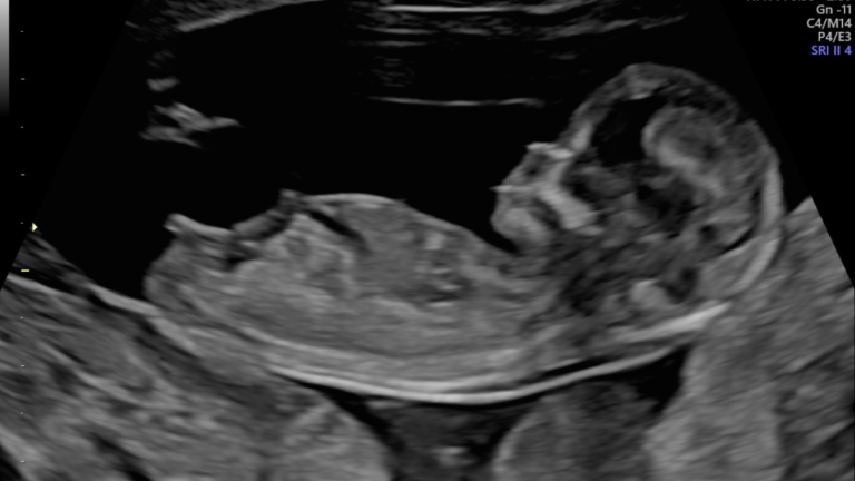 Morfológico de Primeiro Trimestre – o exame mais importante da gestação